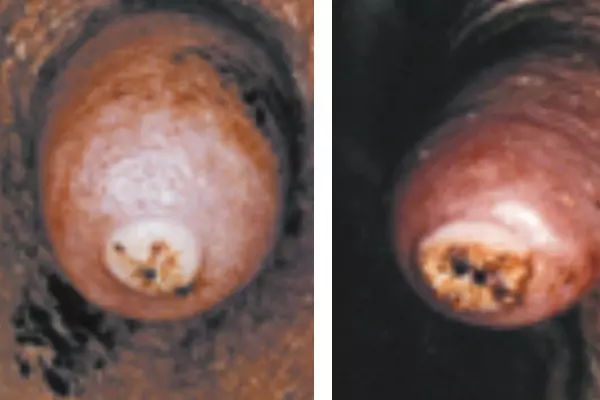 teat scoring hyperkeratosis